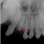 Fractured incisor